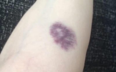 BE CAREFUL, if you get these bruises on your body, it means you have Ca…see more